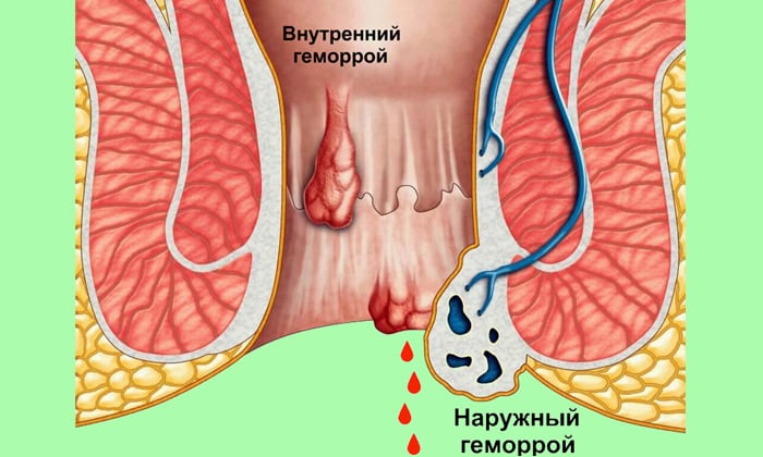 чи Беруть в армію з гемороєм?