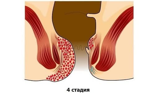 чи Беруть в армію з гемороєм?