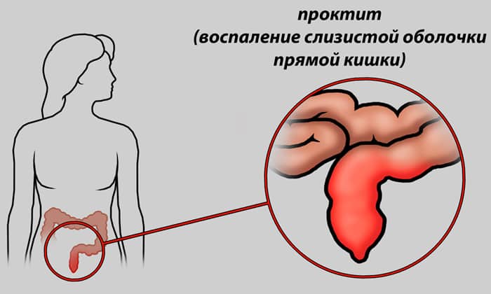 Коли призначається і як проходить лігування гемороїдального вузла?