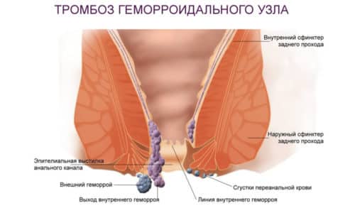 Використання каланхое від геморою Використання каланхое від геморою