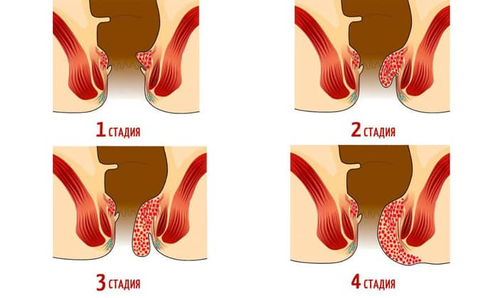 Yak Vpraviti Gemoroj Samomu V Domashnih Umovah Med Arhiv Com