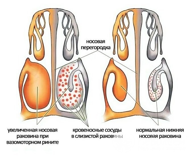 10 методів лікування вазомоторного риніту