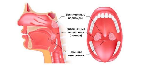 Аденоїди у дітей – лікування в домашніх умовах народними методами