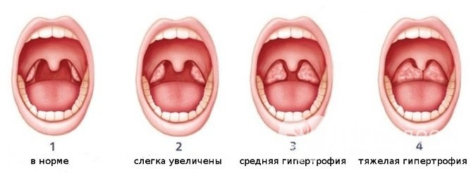 Аденоїдит у дітей: симптоми і лікування