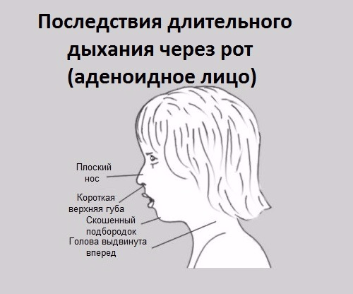 Аденоїдит у дітей: симптоми і лікування