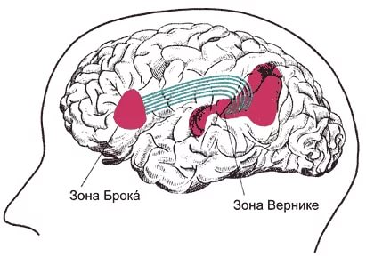 Афазія після інсульту як довго