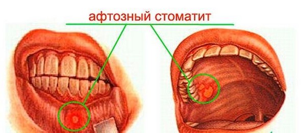 Афтозний стоматит – як виглядає (фото), лікування і симптоми