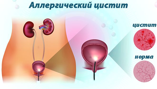 Алергічний цистит як визначити – Цистит