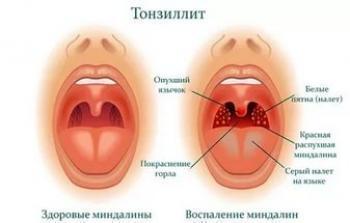 Ангін Хель – інструкція, як приймати спрей дітям