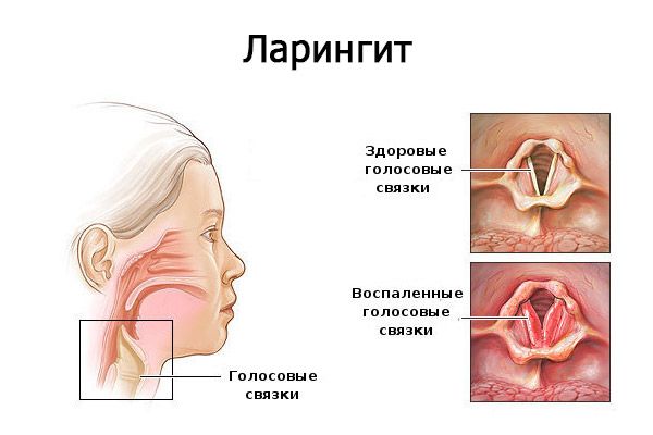 Антибіотики при ларингіті у дітей: препарати при ларинготрахеїті, який вибрати для дитини з температурою