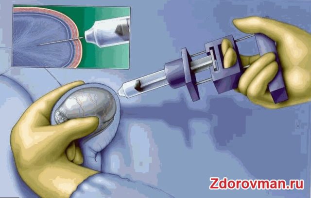 Азооспермія: лікування народними засобами