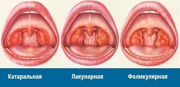 Болить горло боляче ковтати, як лікувати?