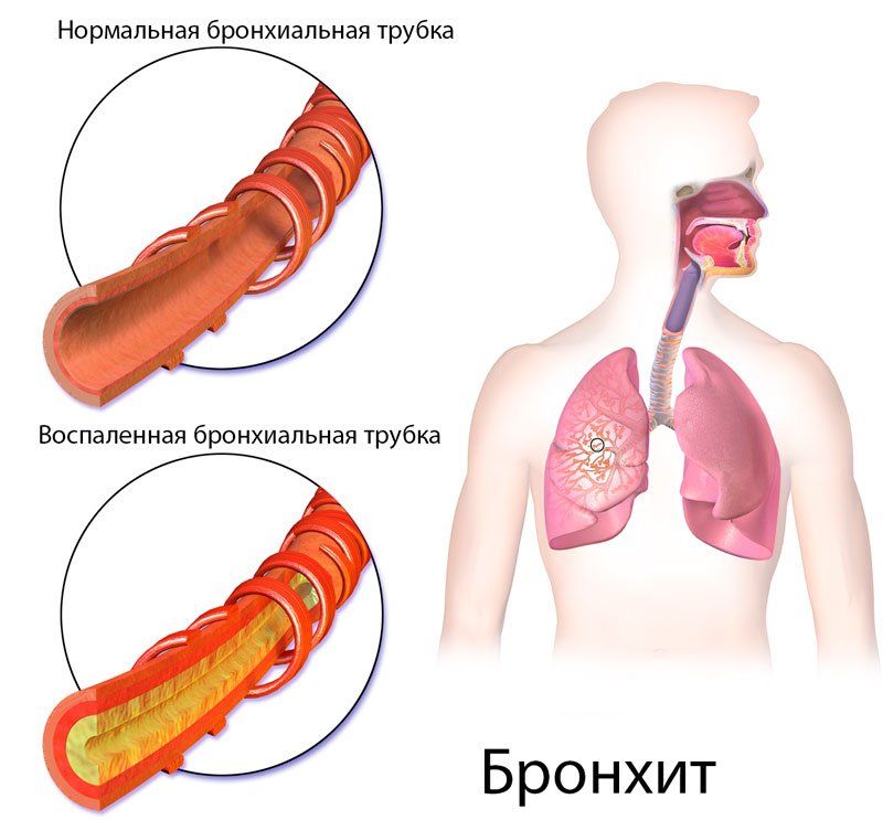 Бронхіт і пневмонія: відмінності, лікування, може бронхіт перейти в запалення легенів