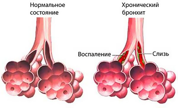 Бронхикум — огляд інструкції та відгуків про застосування еліксиру, пастилок, сиропу – новини медицини