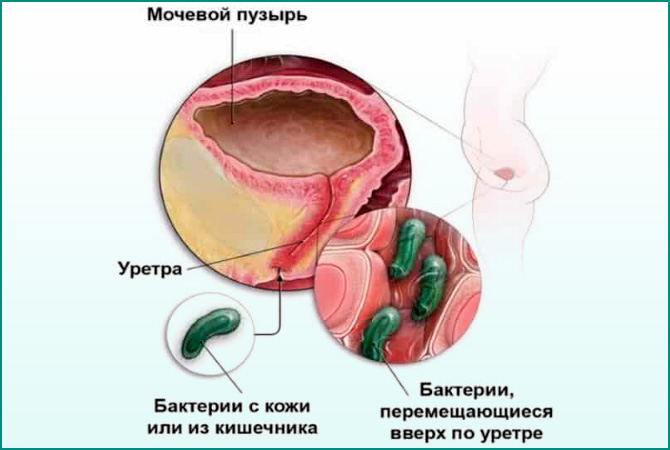 Чи можна вилікувати цистит без антибіотиків у дитини