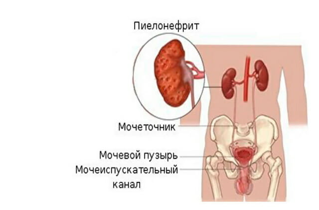 Чим небезпечний цистит – можливі ускладнення і наслідки
