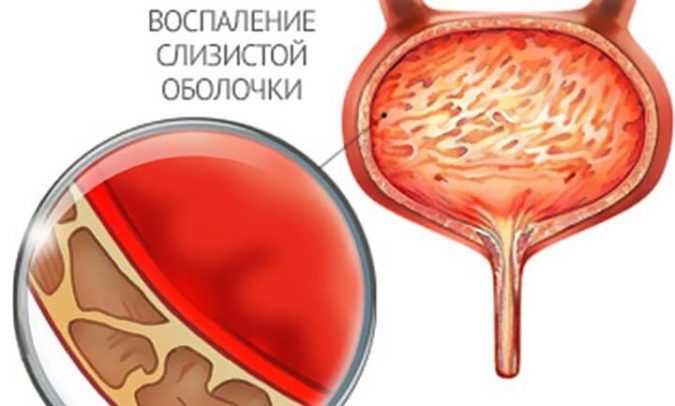 Чим небезпечний цистит – можливі ускладнення і наслідки