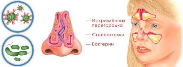 Чим промивати ніс при гаймориті в домашніх умовах