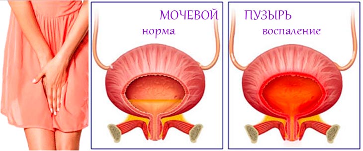 Чим і як лікувати хронічну форму циститу у жінок