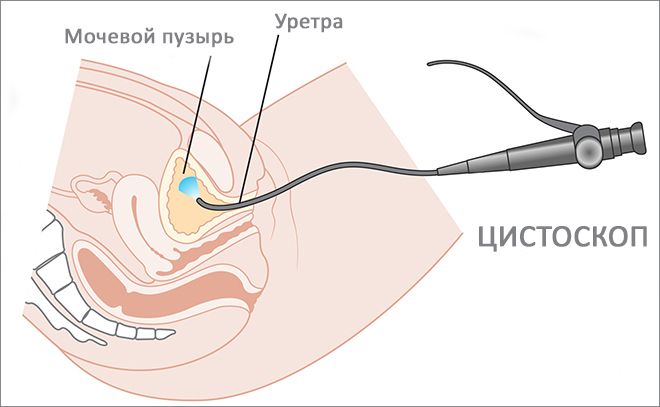 Чим і як лікувати хронічну форму циститу у жінок