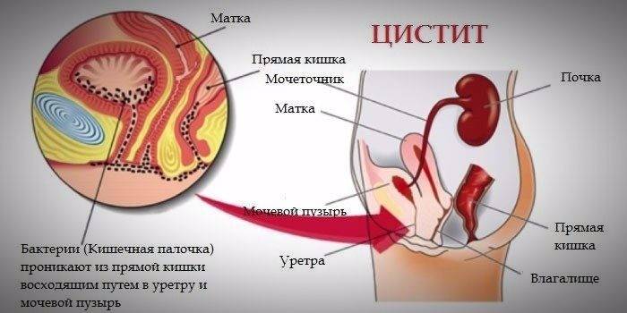 Чим і як лікувати хронічну форму циститу у жінок