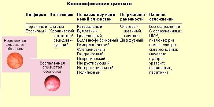 Чим і як лікувати хронічну форму циститу у жінок