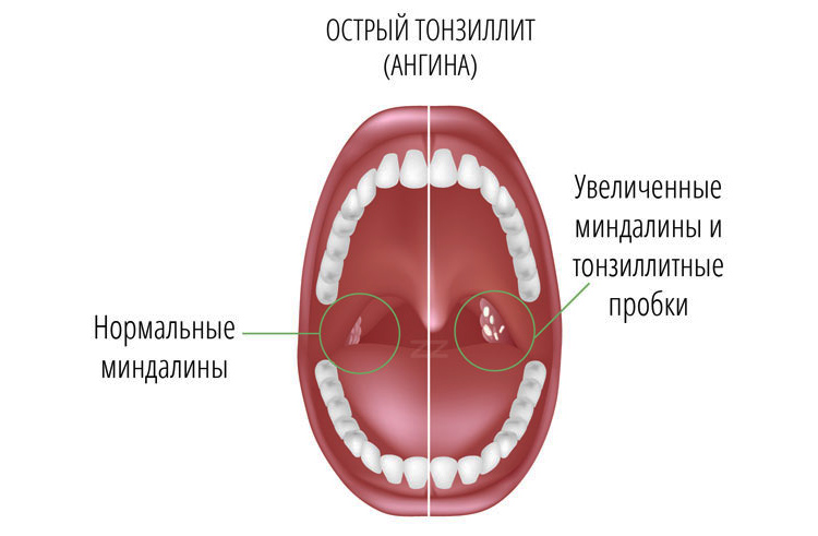 Чим і як полоскати горло при гнійній ангіні
