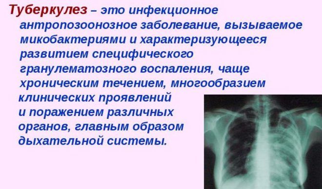 Чим загрожує мокротиння при кашлі і як від неї позбутися