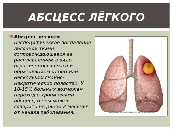 Чим загрожує мокротиння при кашлі і як від неї позбутися