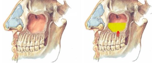 Чому гайморит виникає після видалення зуба