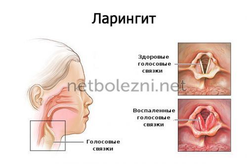 Чому пропав голос що робити і як лікувати