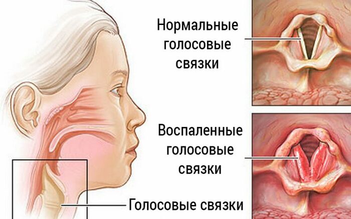 Чому пропав голос що робити і як лікувати