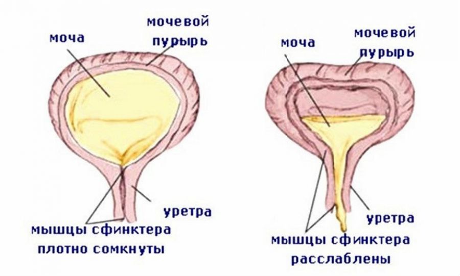 Цистостомія сечового міхура: види, показання та протипоказання