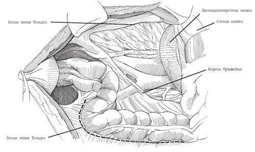 Цистотомія сечового міхура: особливості проведення операції