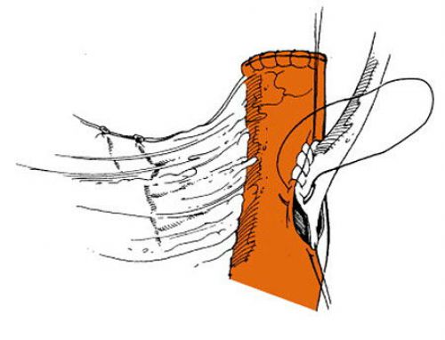 Цистотомія сечового міхура: особливості проведення операції