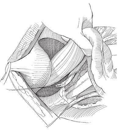 Цистотомія сечового міхура: особливості проведення операції