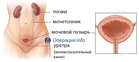 Цистотомія сечового міхура: особливості проведення операції