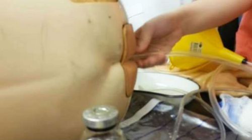 Цистотомія сечового міхура: особливості проведення операції