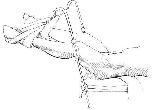 Цистотомія сечового міхура: особливості проведення операції