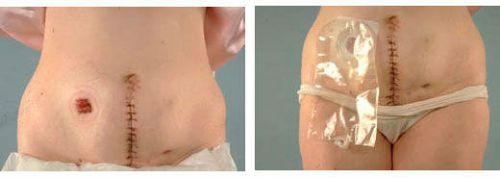 Цистотомія сечового міхура: особливості проведення операції