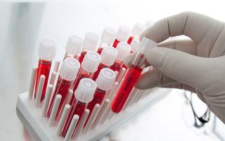 Діагностика гіпотиреозу з допомогою лабораторних досліджень
