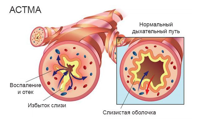 Дихальну гімнастику і ЛФК при бронхіальній астмі приклади вправ для дорослих і дітей