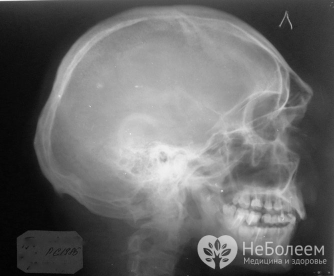 Дитина вдарився носом перша допомога та можливі ускладнення