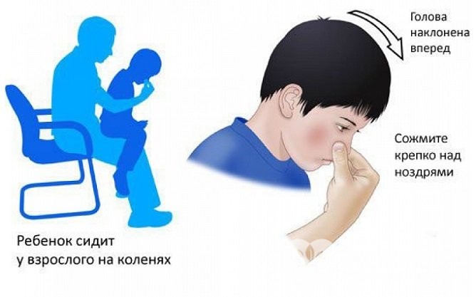 Дитина вдарився носом перша допомога та можливі ускладнення