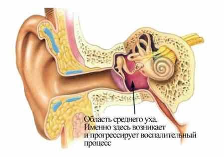 Ефективні способи лікування фарингіту в домашніх умовах