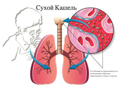 Ефективні засоби для дітей від сухого кашлю
