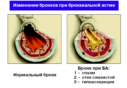 Ефективний Пульмикорт при ларингіті