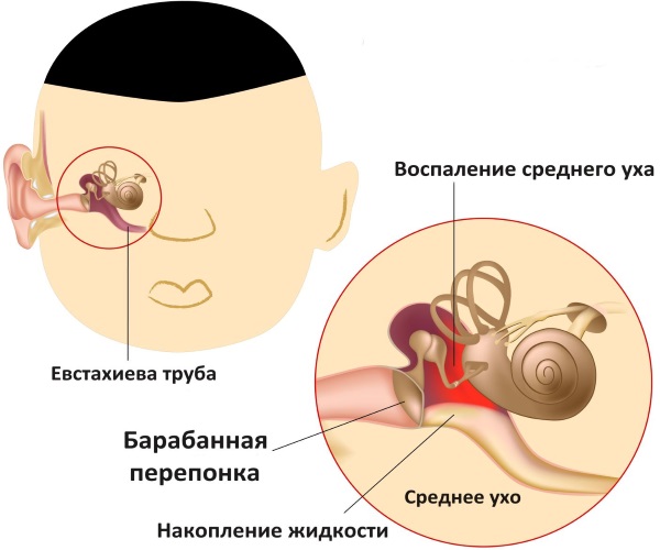 Електрофорез УВЧ та інші методи фізіотерапії при отиті