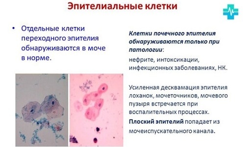 Епітелій в сечі — Яка норма вмісту епітелію в сечі?