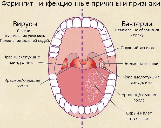 Фарингіт у дітей – симптоми, лікування, причини, профілактика